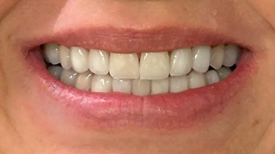 Lentes de Porcelana