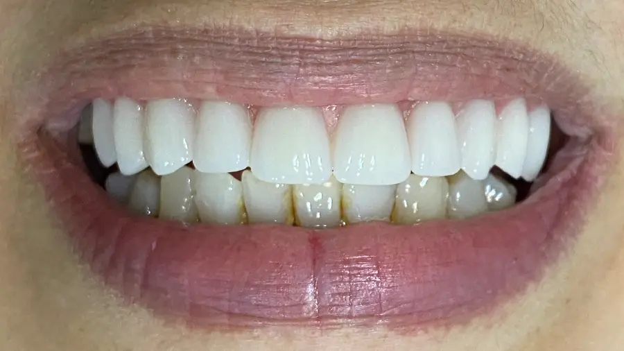 Implantes Dentários